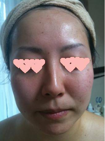 グリーンピール5daysビフォーアフター